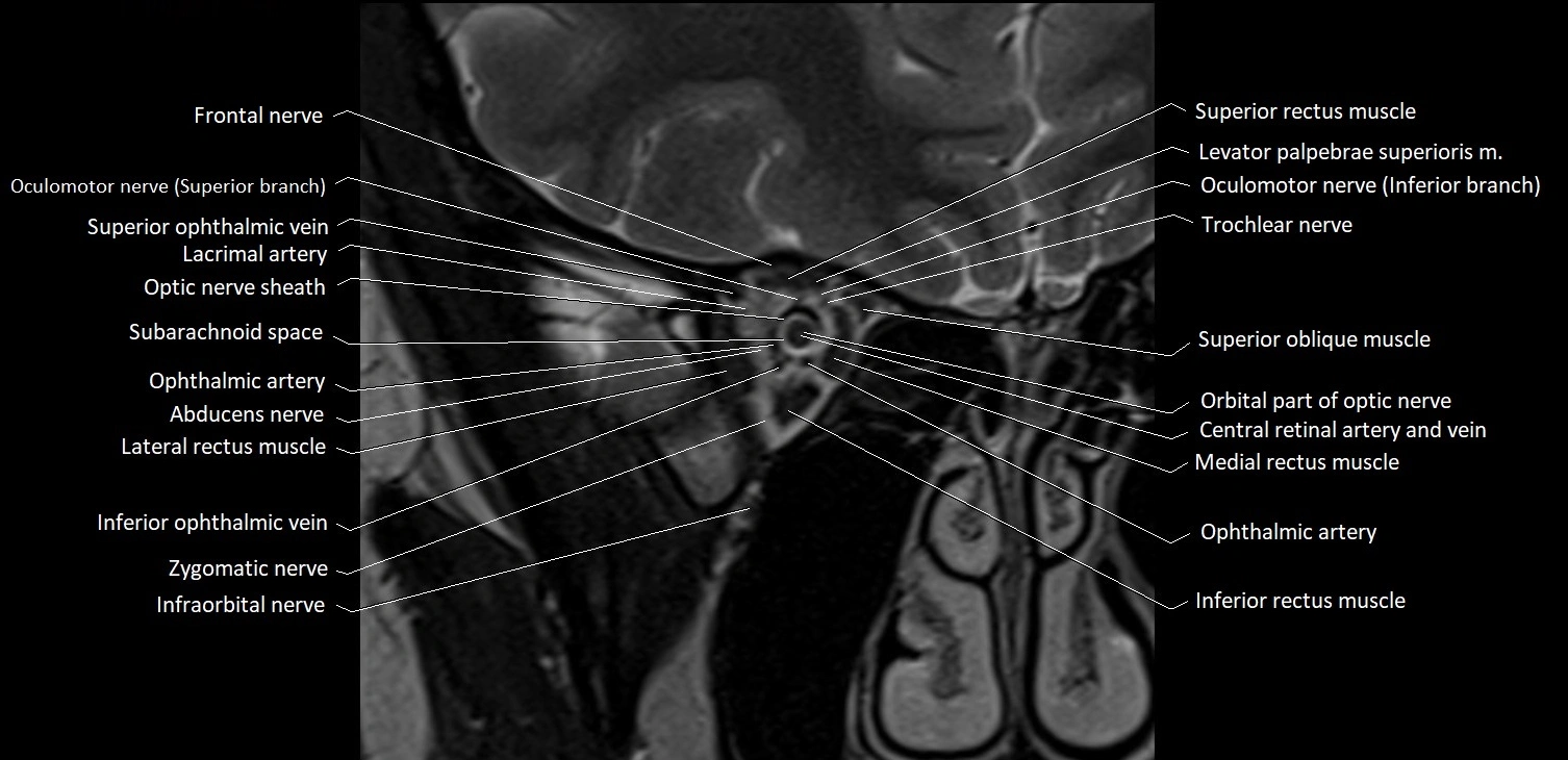MRI Orbit coronal cross sectional anatomy image 12.webp